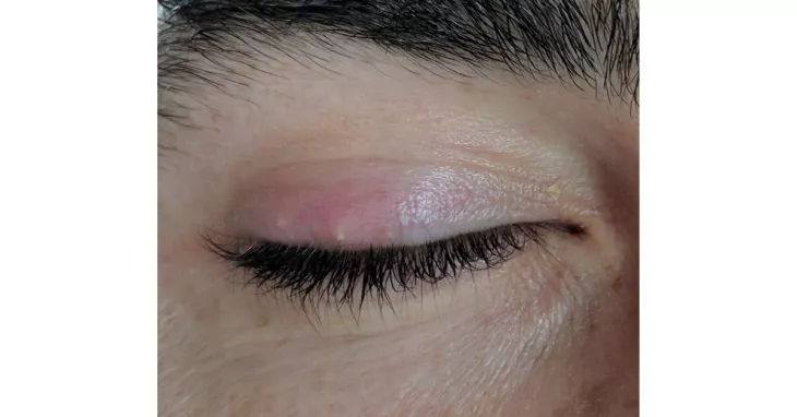 8 Ways Of How To Get Rid Of A Stye