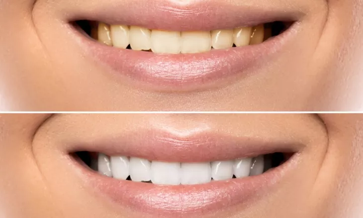 Causes of tooth discoloration