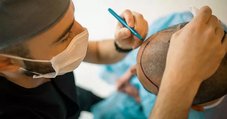 synthetic hair transplant 