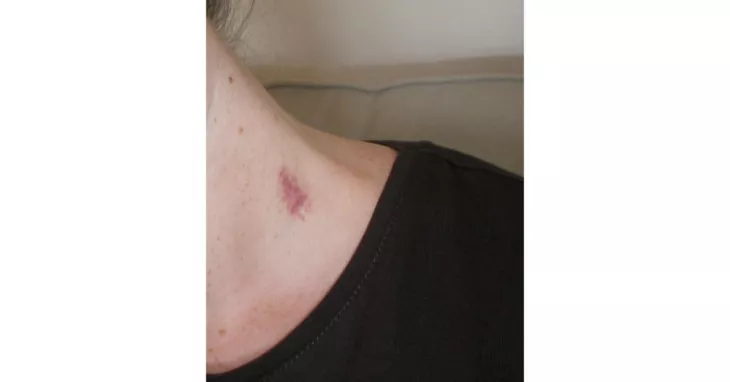 8 Tips On How To Get Rid Of Hickeys