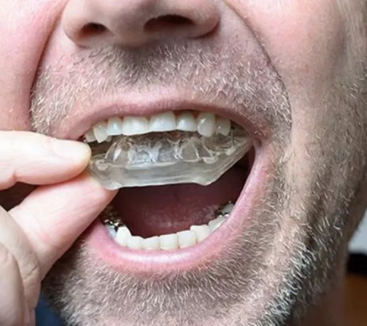 custom mouthguards
