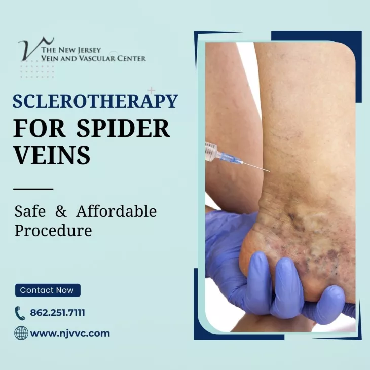  Spider Veins  Treatment in New Jersey