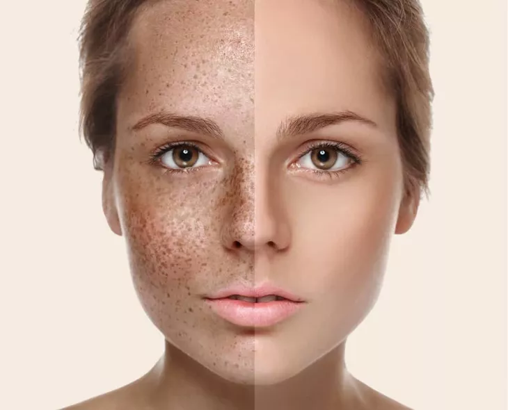 Skin Rejuvenation