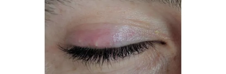 8 Ways Of How To Get Rid Of A Stye