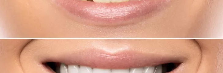 Causes of tooth discoloration