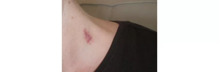 8 Tips On How To Get Rid Of Hickeys