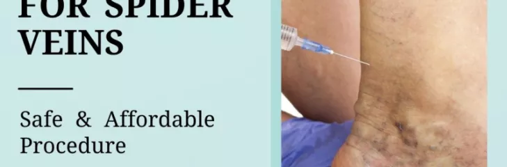  Spider Veins  Treatment in New Jersey