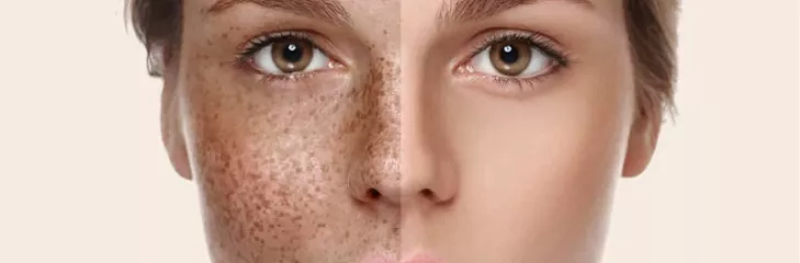 Skin Rejuvenation