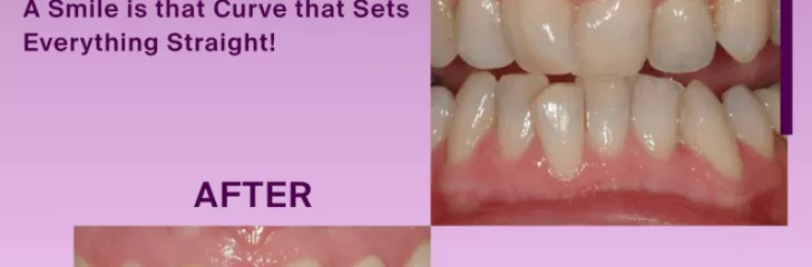 Tooth Replacement services in Chennai