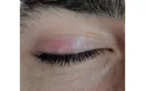 8 Ways Of How To Get Rid Of A Stye