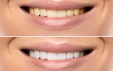 Causes of tooth discoloration