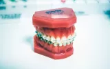 Invisible Braces