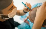 synthetic hair transplant 