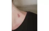 8 Tips On How To Get Rid Of Hickeys