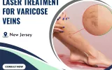 Laser treatment for varicose veins by NJVVC in Randolph, New Jersey