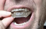 custom mouthguards
