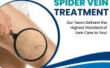 spider vein treatment by Dr. Stuart Miller in Randolph,NJ