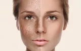 Skin Rejuvenation